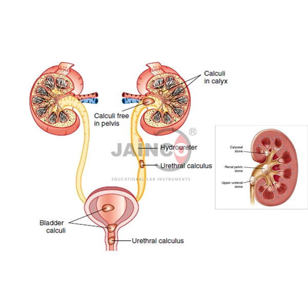 Urinary Tract Calculi Model