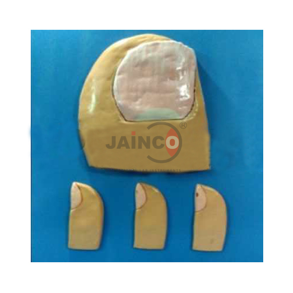 Koilonychia Model