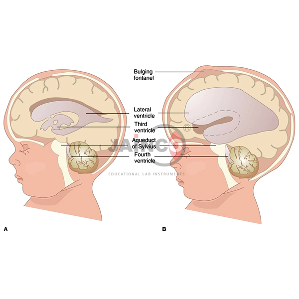 Hydrocephalus Model