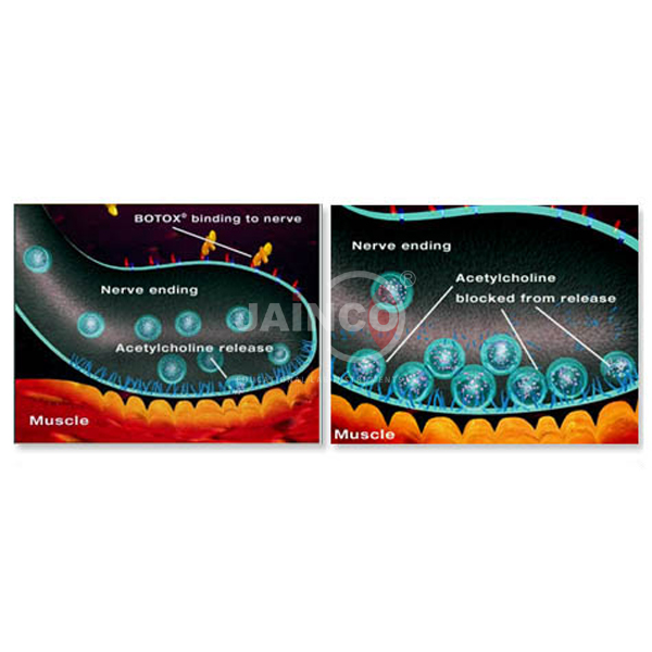 Mechanism of Botulinum Toxin Model